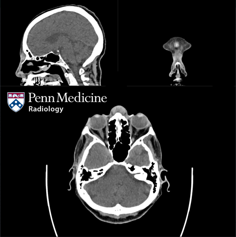74-year-old woman with sinusitis