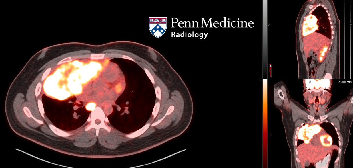 22-year-old man with fever, chills, and productive cough
