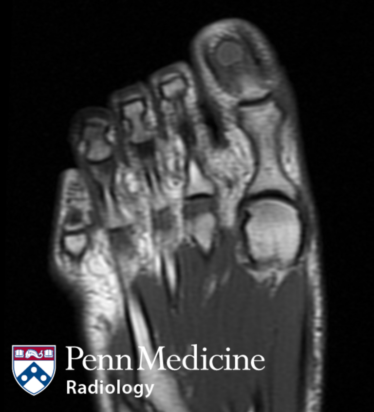 27-year-old woman with toe pain
