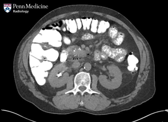 72-year-old man with abdominal pain