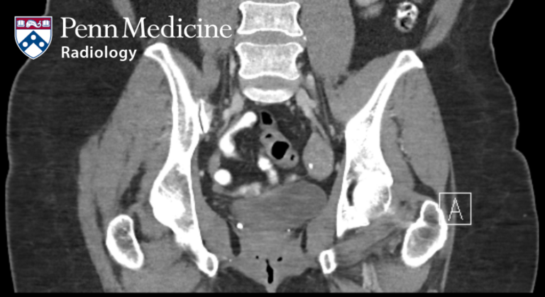 52-year-old woman with left lower quadrant pain