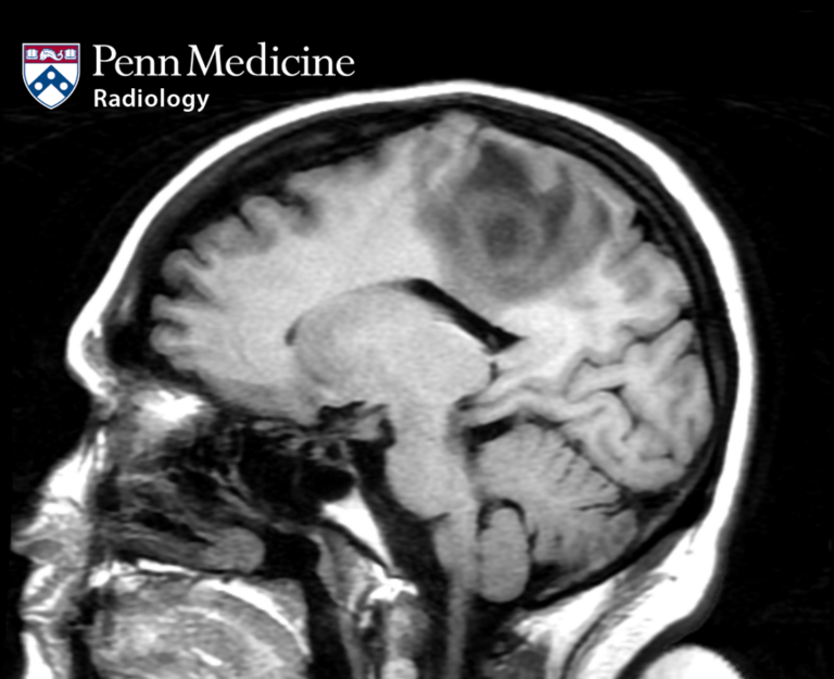 33-year-old woman with weakness