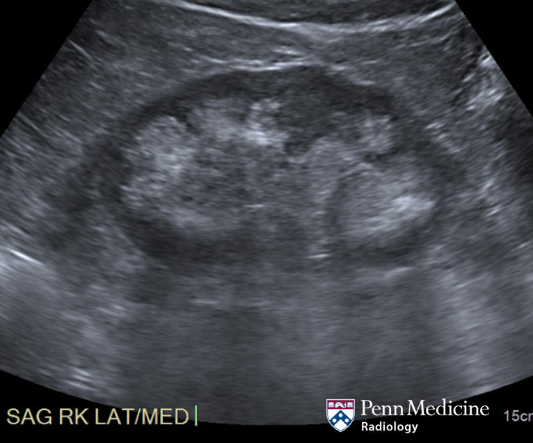 63-year-old woman with flank pain