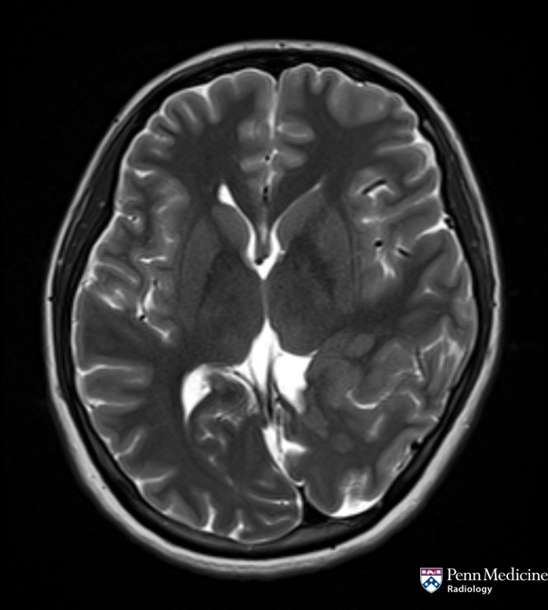 19-year-old woman with new seizures