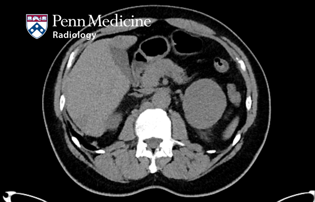 61-year-old man with hematuria