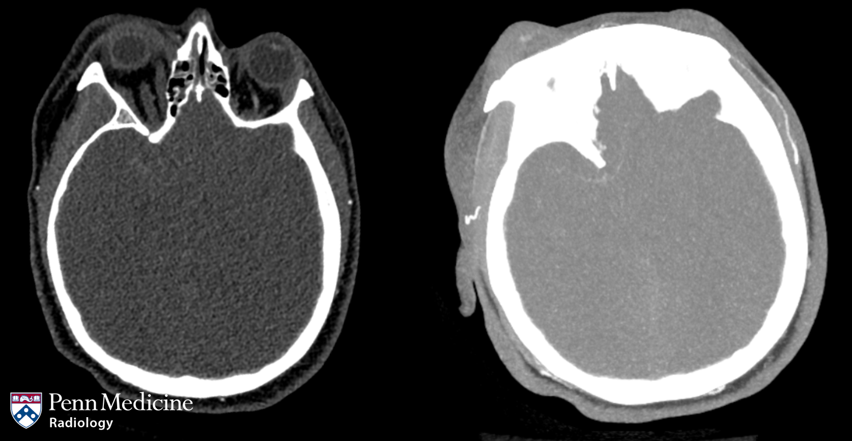 A woman in her 20s after severe motor vehicle accident