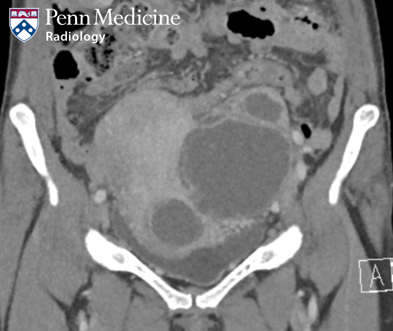 37-year-old postpartum woman with urinary retention and adnexal mass