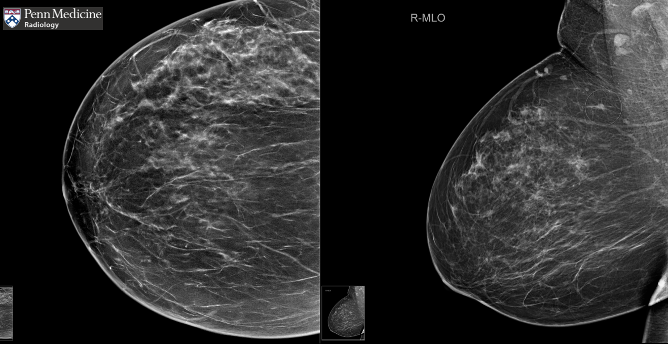53-year-old woman called back for abnormal screening mammogram