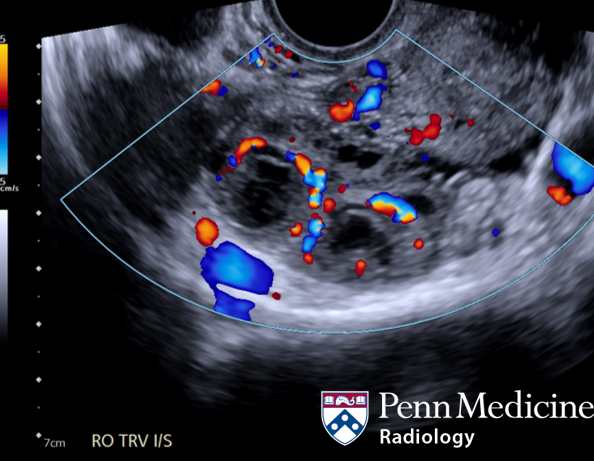 31-year-old woman with worsening pelvic pain