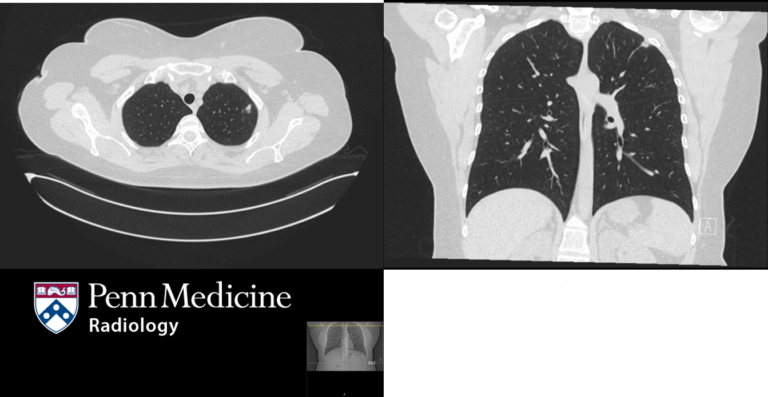 31-year-old woman with progressive, non-tender swelling in right thigh