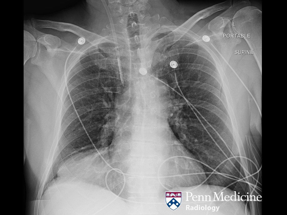 62-year-old man with headache