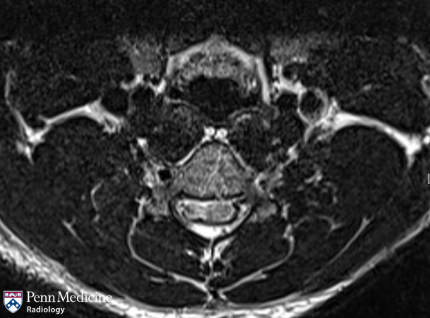 21-year-old man with gradual hand weakness