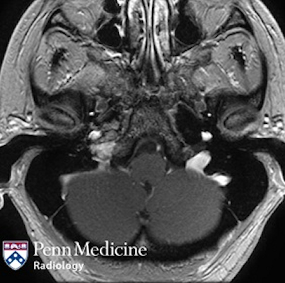 Woman in her 50s with unilateral hearing loss and vertigo