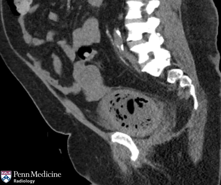 51-year-old woman with dysuria
