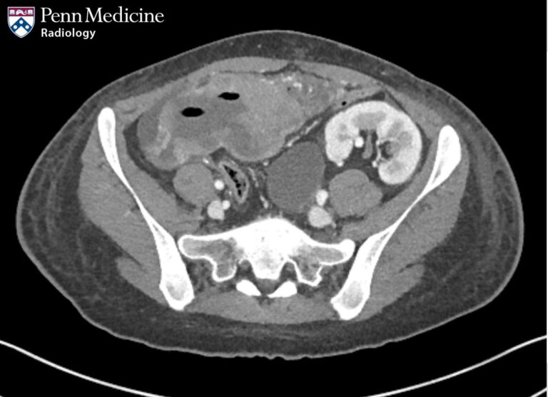 21-year-old woman with abdominal pain