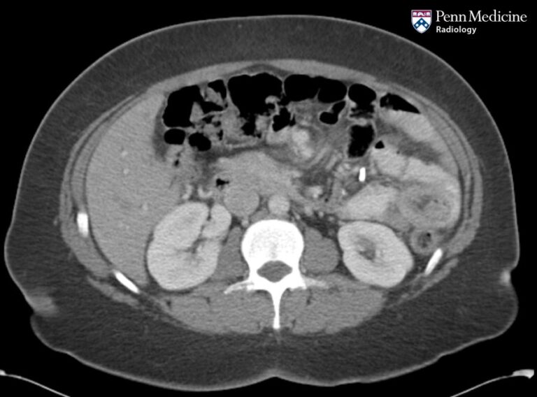 47-year-old woman with abdominal pain