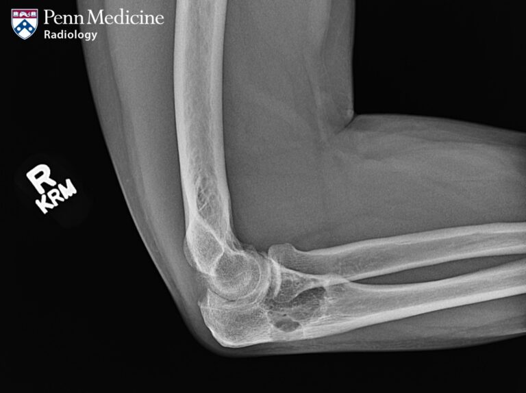 32-year-old man with right elbow pain