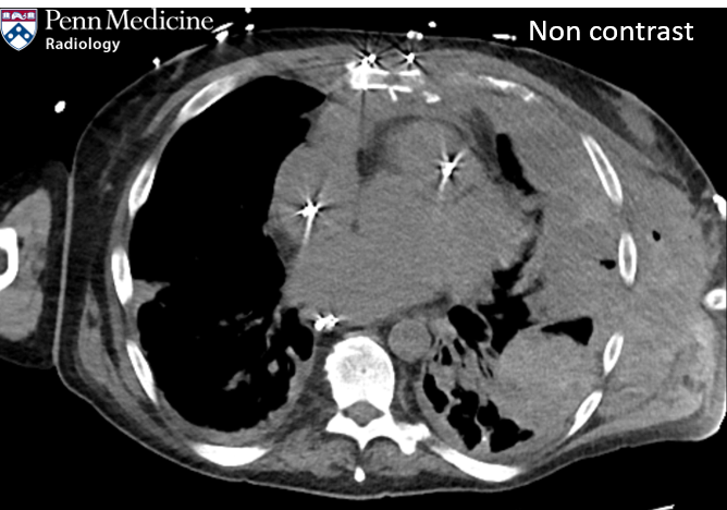 61-year-old male ICU patient with increasing shortness of breath