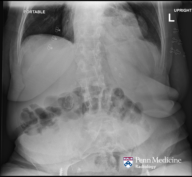 A 68-year-old woman with diffuse abdominal pain and bloating