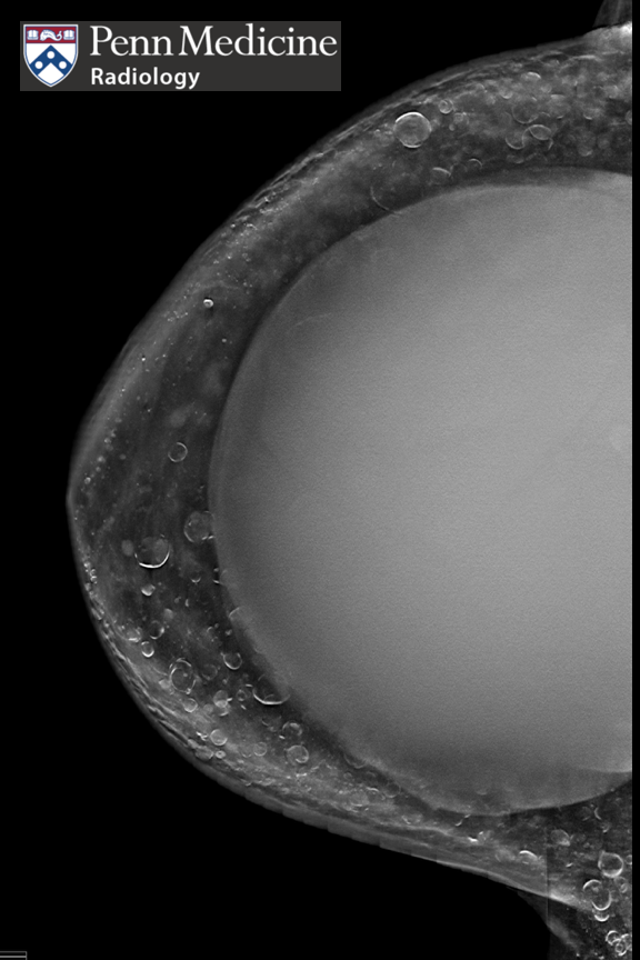 39-year-old patient with an axillary mass