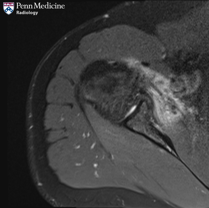 44-year-old woman with shoulder pain