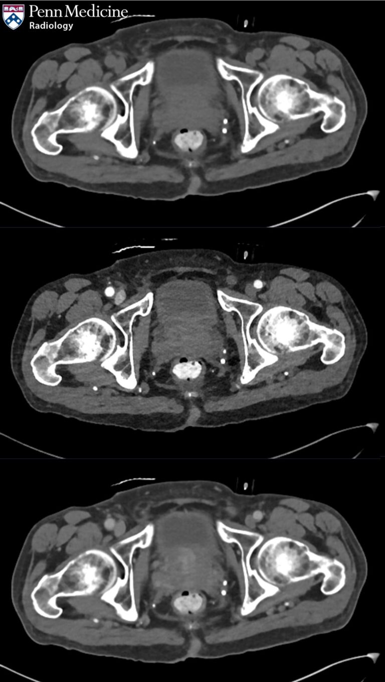 64-year-old man with groin pain