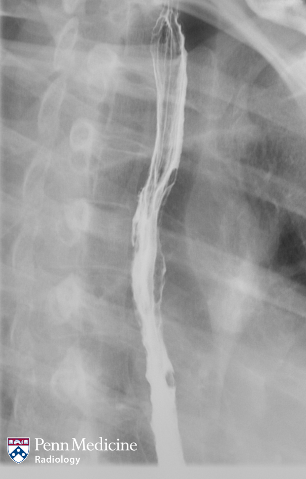 27-year-old woman with chest pain and difficulty swallowing