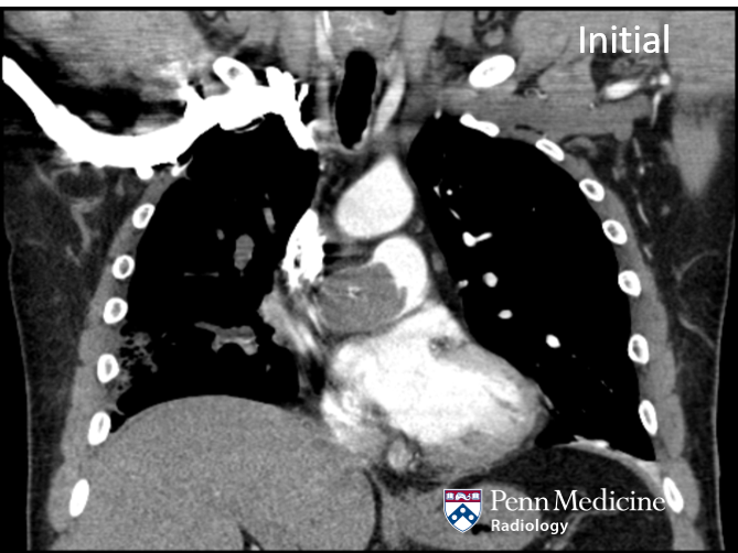 63-year-old man with cough and dyspnea