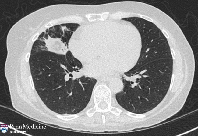 66-year-old woman with dry cough
