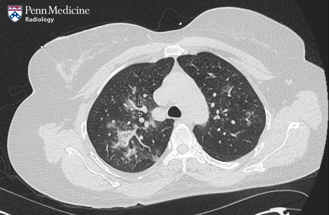 56-year-old woman with fever, cough, productive sputum, and weakness