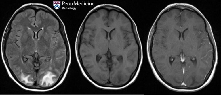 48-year-old woman with headaches