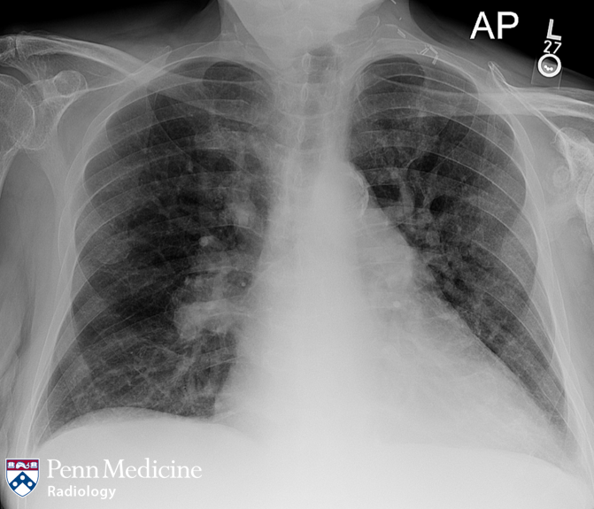 Man in his 80s with palpitations