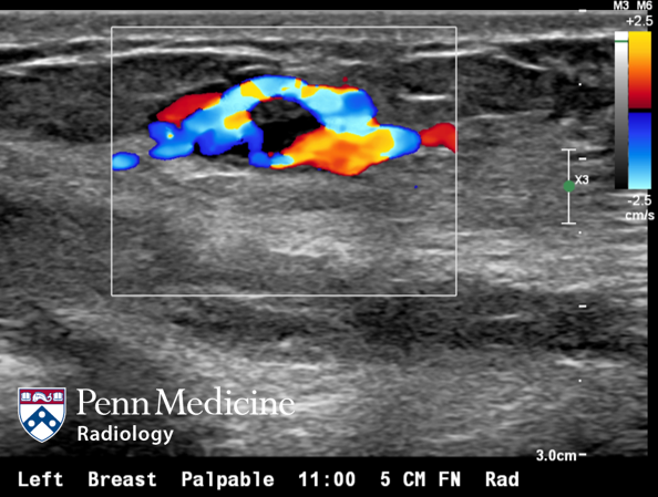 22-year-old woman with left breast lump