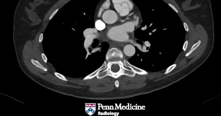 42-year-old woman with sudden-onset epigastric pain radiating to her back